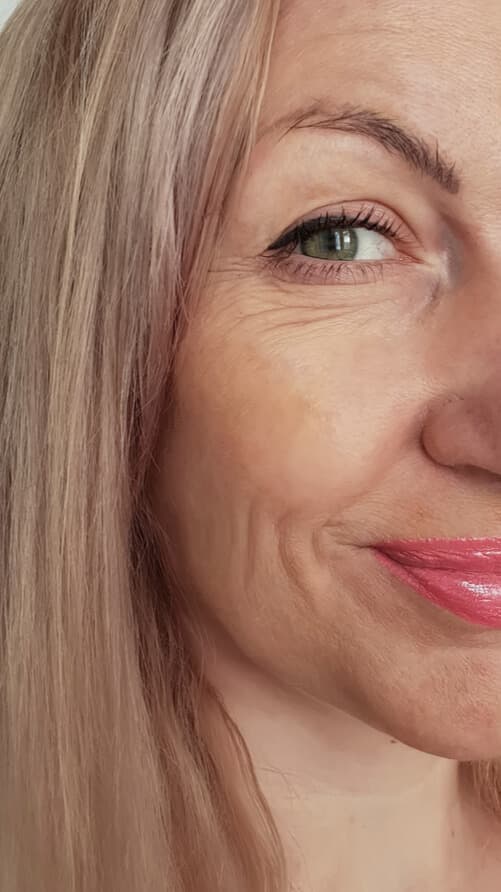 Wrinkle reduction results