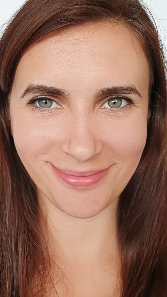 Under-eye filler results