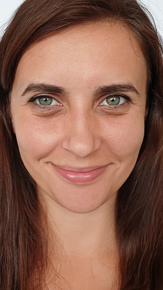 Under-eye filler results