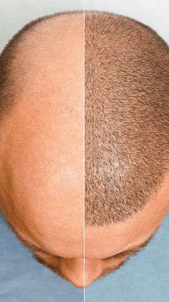 Hair transplant